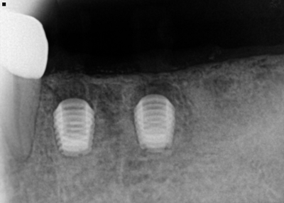 bicon dental implant